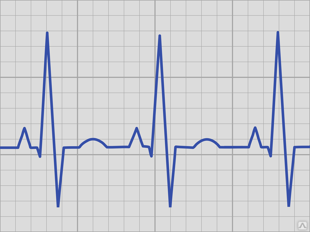 Экг сердца москва. Паттерн Аслангери на ЭКГ. Электрокардиограмма график. ЭКГ диаграмма. ЭКГ сердца.